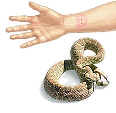 Snakebite!
