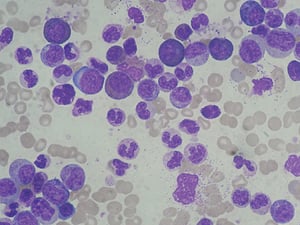 Free cancer treatment?