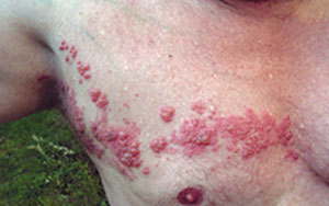 Rash of rashes