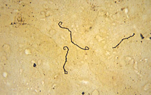 Leptospirosis