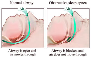 Sleep apnea