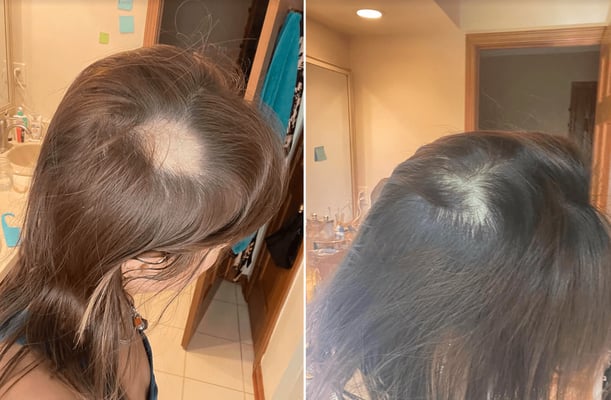 What is it like to have alopecia?